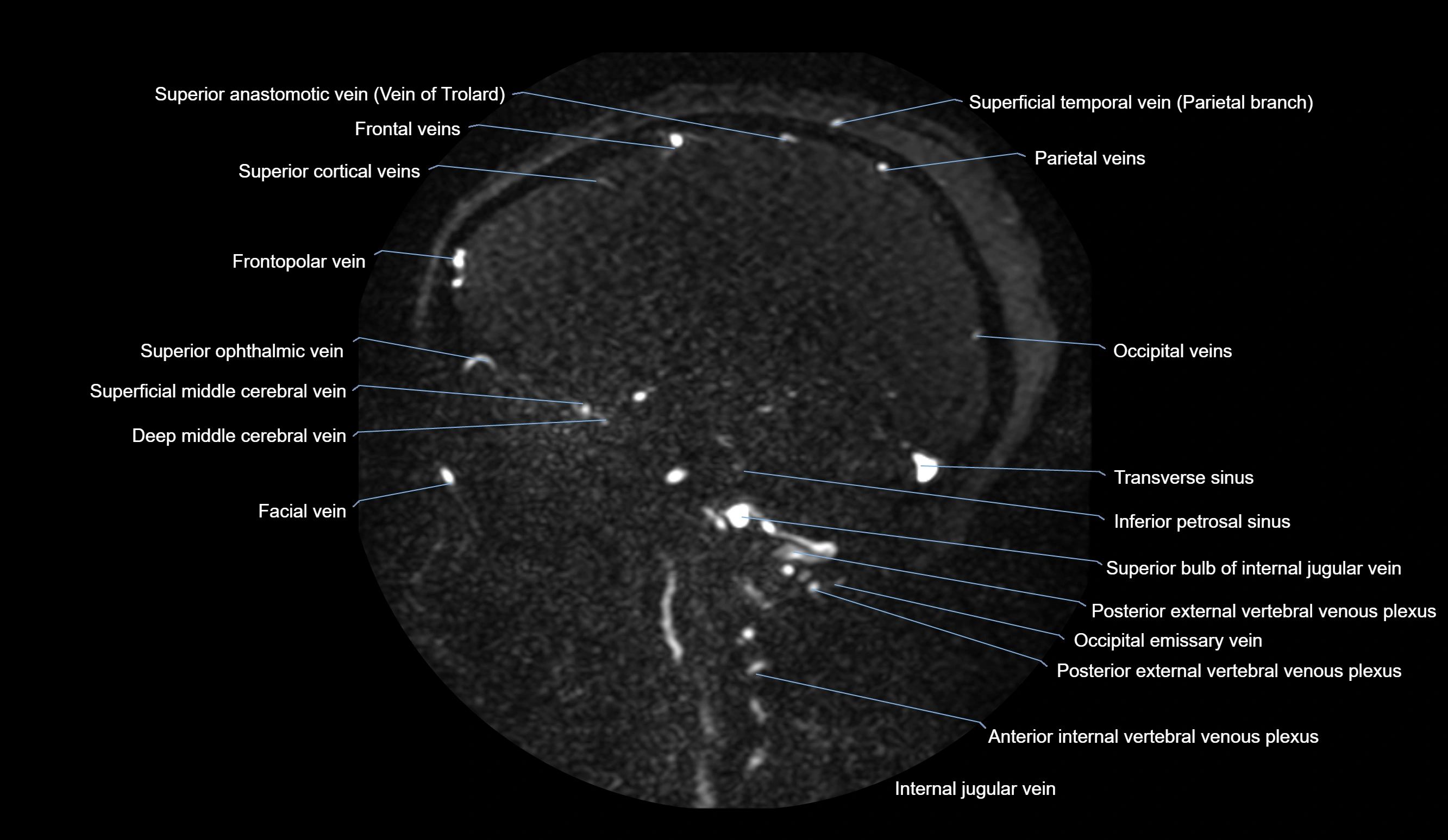 MRV brain sagittal anatomy 3T MRI labelledimages -00032.webp